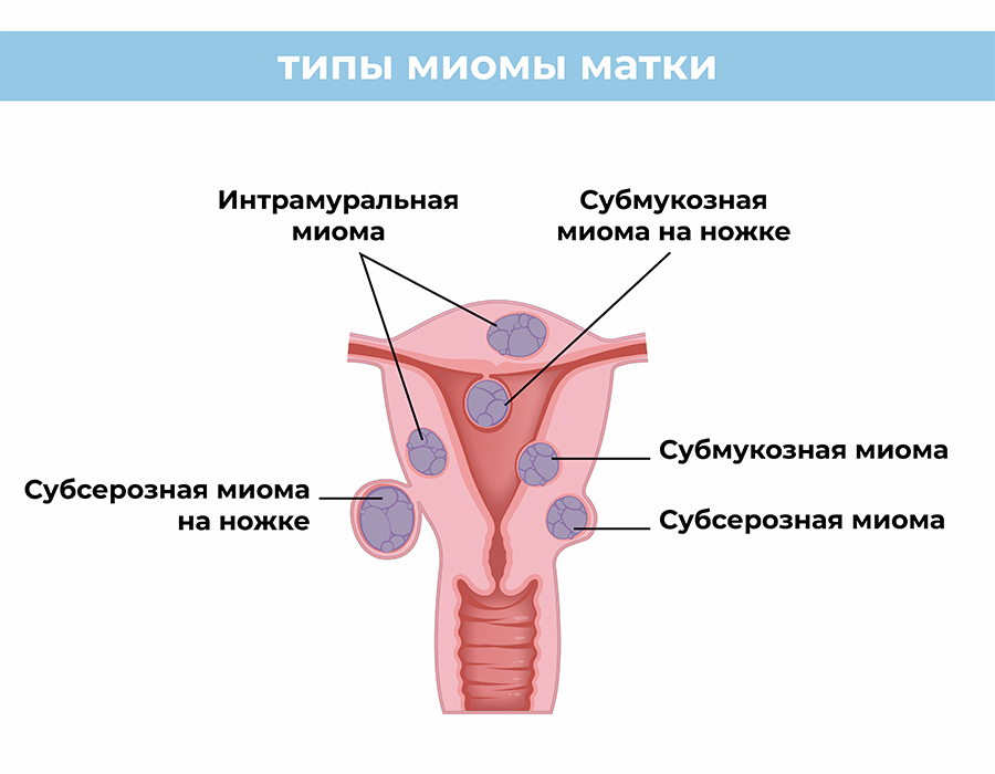 лечение миомы матки