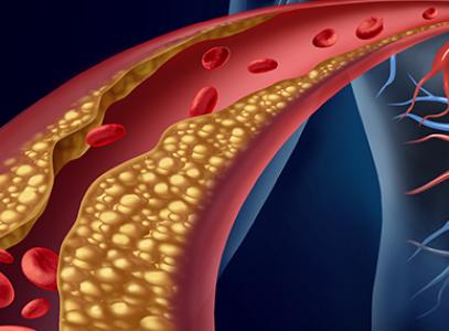 АТЕРОСКЛЕРОЗ нижних конечностей. Чек-лист
