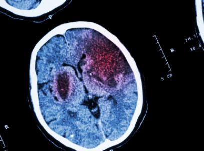 инсульт лечение и диагностика