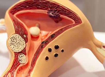 лечение миомы матки